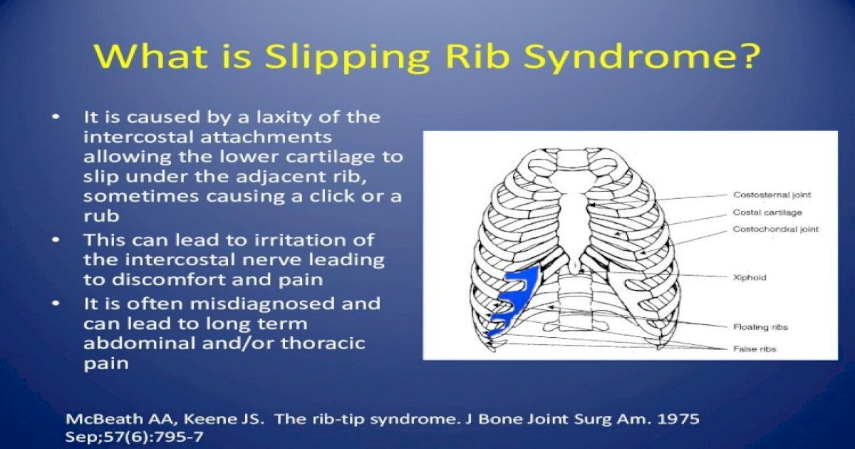 What Is Slipping Rib Syndrome Semantic Scholar · 2017 10 19