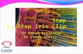Step by step IRIS clip