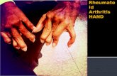 Rheumatoid arthritis   hand