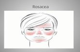 Rosacea presentation