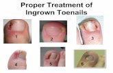 Proper Treatment of Ingrown Toenail - Dr. Donald Pelto