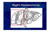 Right hepatectomy - step by step description for surgeon.