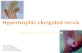 Hypertrophic elongated cervix (elongation of cervix)