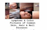 Symptoms and pictures of common skin, hair and nail diseases