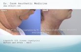 Dr. Darm Lipolift III Before after Neck