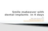 Smile makeover with dental implants in 4 days