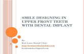 Smile designing in upper front teeth with dental implant