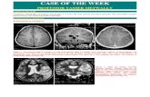 Case record...Dysembryoplastic neuroepithelial tumor
