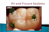pit and fissure sealant theory class