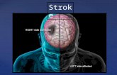 Stroke. Stroke is the 3rd leading cause of death. Every 5 minutes someone has a stroke A woman is 3 times more likely to have a stroke than breast cancer.