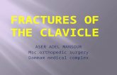Fractures of clavicle aser