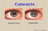 Cataract Normal Eye Cataracts Bhaveet. R. Chudasama.