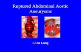 Ruptured Abdominal Aortic Aneurysms Eliza Long. Treatment of the Ruptured Abdominal Aortic Aneurysm Diagnosis –Clinical –Imaging Resuscitation Surgery