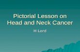 Pictorial Lesson on Head and Neck Cancer H Lord. Intra-Oral Tumours.