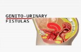 (21) Genito-urinary Fistula