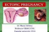 Ectopic pregnancy for undergraduate