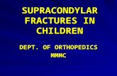 Supracondylar fractures in_children