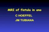 Abdominal imaging ano fistula jm tubiana