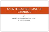 A Case of Hepato-Pulmonary Syndrome