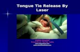 Laser Release Tongue Tie