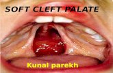 Maxillofacial prosthesis of soft cleft palate
