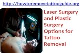 Laser surgery and plastic surgery options for tattoo removal