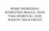 Home Remedies Reviews:Removing Moles, Skin Tag Removal And Warts Treatment
