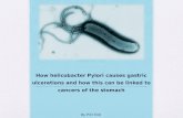 How Helicobacter Pylori can cause gastric ulcerations and how this can lead to cancers of the stomach - Piril Erel