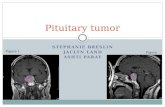 Pituitary tumor powerpoint table 3
