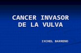 Cancer invasor de la vulva