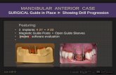 14 mandibular anterior case   open guide sleeve  drill progression