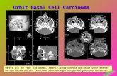 Orbit Basal Cell Carcinoma