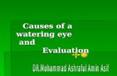 Eye presentation causes of a watering eye and evaluation,dr.mohammad ashraful amin asif