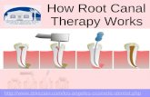 How root canal therapy works