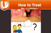 U Don’t KNOW How to Treat Tonsillitis/Tonsil Stones Fully