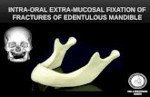 Intra-oral Extra-Mucosal Fixation of Atrophic Mandible