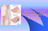 Ovarian tumors and cysts