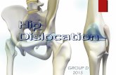 Hip dislocation