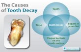 the cause of teeth decay