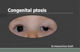 Congenital ptosis