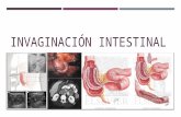 Invaginación intestinal