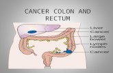 CANCER COLON AND RECTUM (WARDAH).ppt
