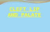 Cleft Lip and Palate presentation