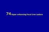 74 hyper enhancing focal liver lesions
