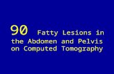 90 fatty lesions in the abdomen and pelvis