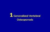 1 generalized vertebral osteoporosis