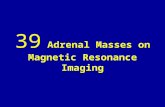 39 adrenal masses on magnetic resonance imaging