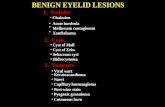 Mata Benign Eyelid Lesions(1)