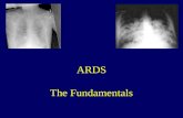 ARDS The Fundamentals. Objectives Know the epidemiologic risk factors for ARDS Understand the pathogenesis of lung dysfunction in ARDS Know how to diagnose.