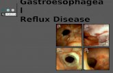 Gastroesophageal Reflux Disease. “a prevalent and chronic condition in which reflux of the stomach contents into the oesophagus causes a range of troublesome.